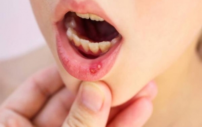Khám phá những vị thuốc Nam chữa nhiệt miệng