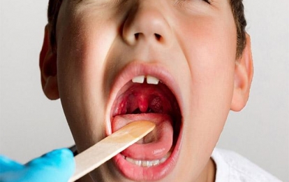 Cách chữa viêm amidan bằng Đông y hiệu quả cho trẻ em