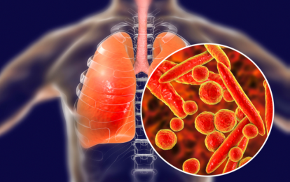 Bác sĩ cảnh báo về bệnh lao phổi và những điều cần biết