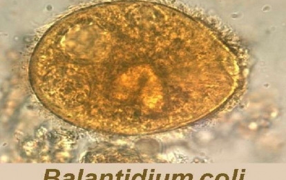 Bác sĩ cảnh báo bệnh do Balantidium coli: Cách nhận biết và phòng bệnh