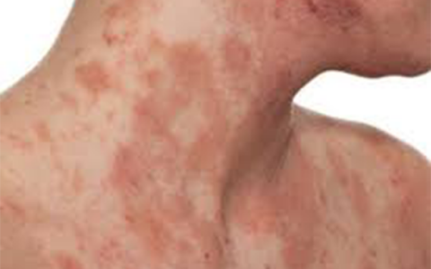 Điều trị viêm da cơ địa qua các phương thức Y học cổ truyền