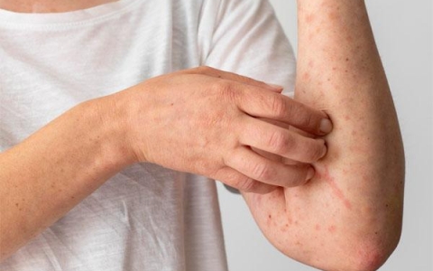 Viêm da cơ địa và phương pháp điều trị bằng Đông y