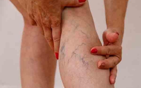 Tìm hiểu về các phương pháp điều trị suy giãn tĩnh mạch bằng Đông y