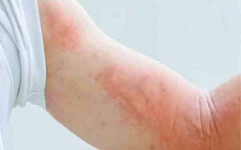 Các phương pháp trị mẩn ngứa hiệu quả theo Y học cổ truyền