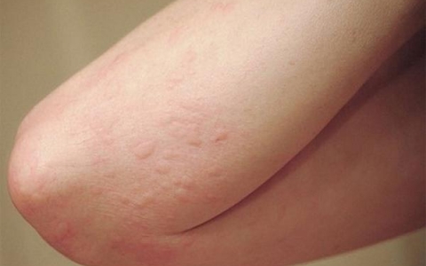 Các bài thuốc Đông y hiệu quả chữa mề đay